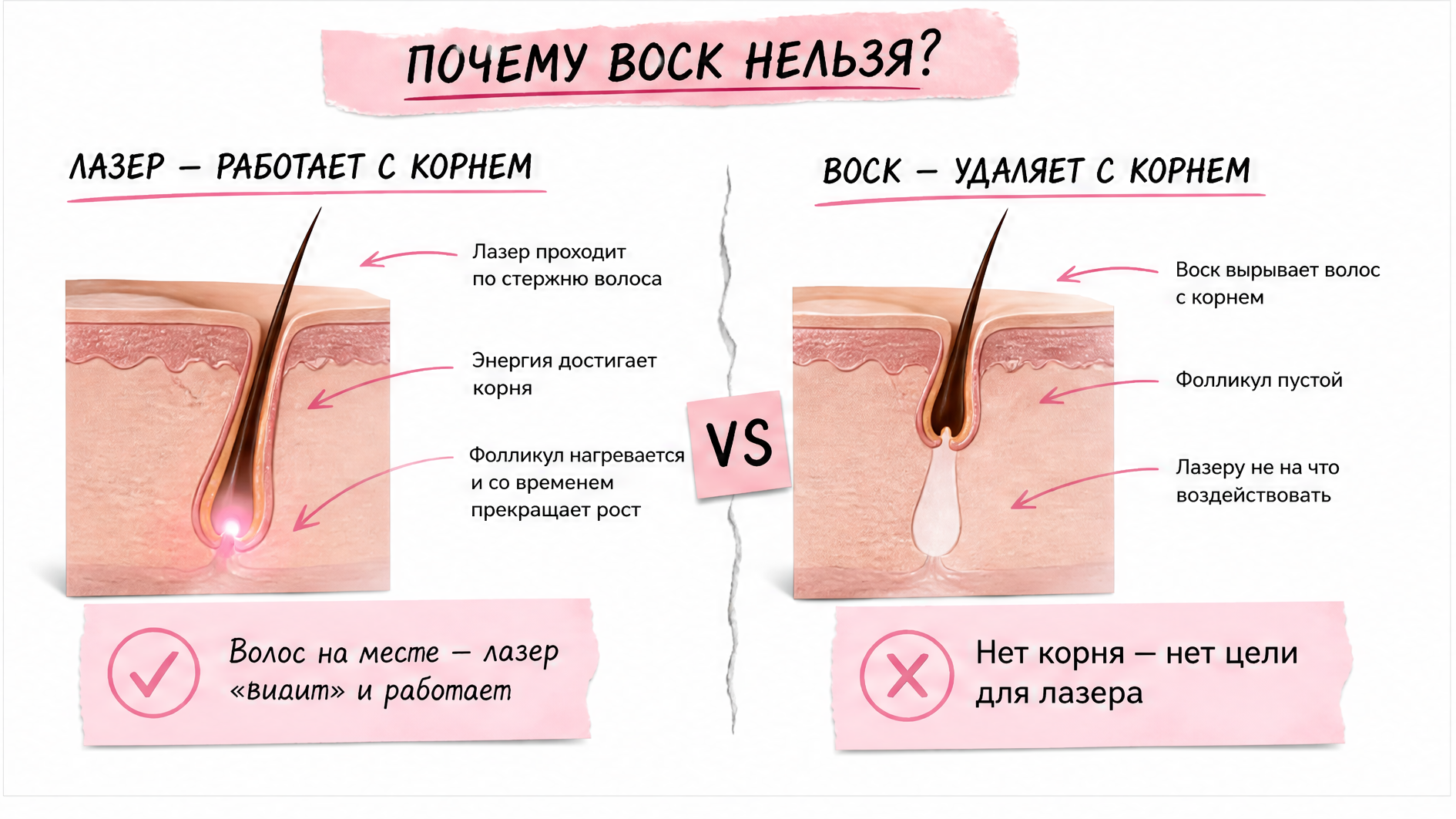 Схема стержень волоса для лазера vs воск вырывает корень