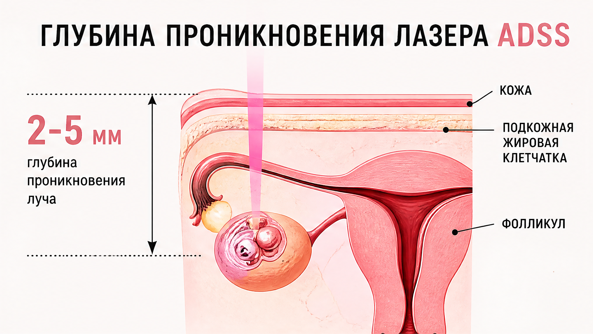 Схема глубины проникновения лазера 2–5 мм и расположения миомы в матке