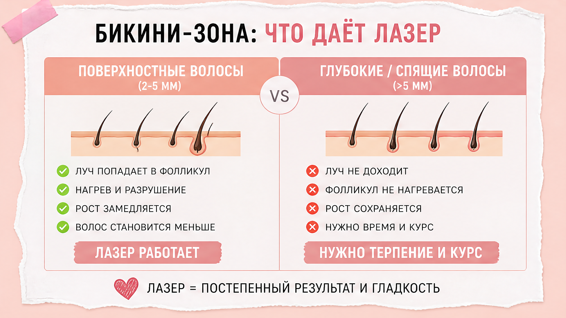 Сравнение зон бикини и глубокого бикини при стабильной миоме